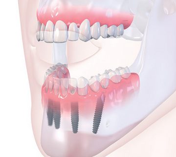 کاشت ایمپلنت