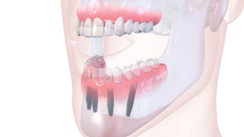 کاشت ایمپلنت