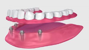 اوردنچر بر پایه ایمپلنت دندان