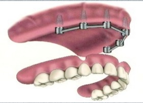 اوردنچر بر پایه ایمپلنت دندانص