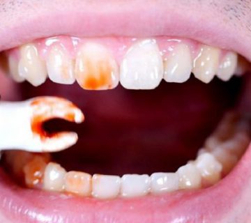 جراحی دندان عقل