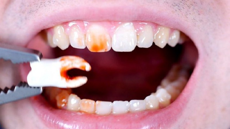 جراحی دندان عقل