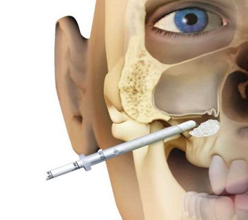جراحی سینوس لیفت