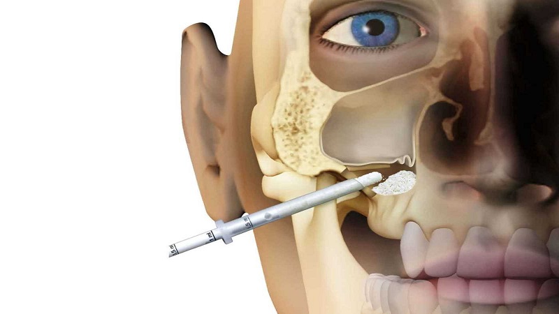 جراحی سینوس لیفت