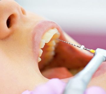 درمان ریشه (عصب کشی)