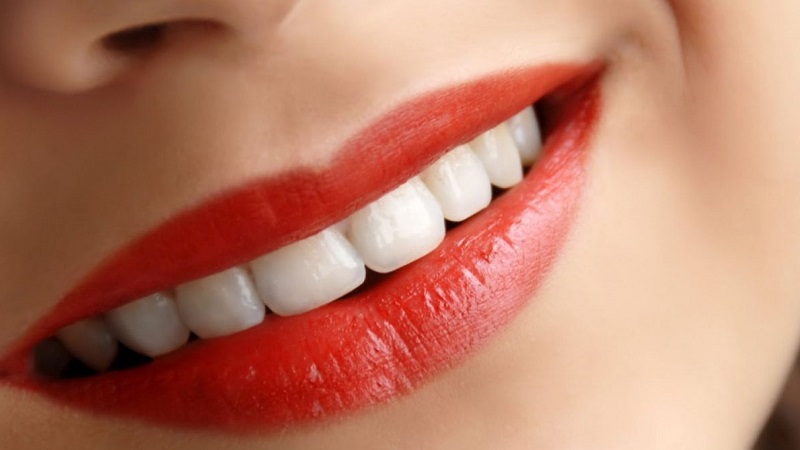 لمینت سرامیکی