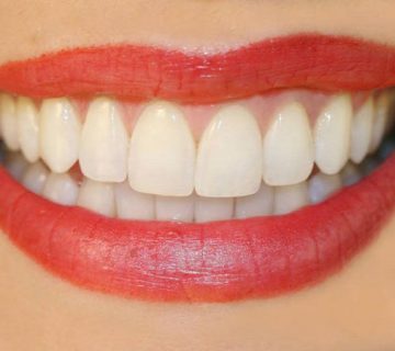 هم سطح کردن دندان ها