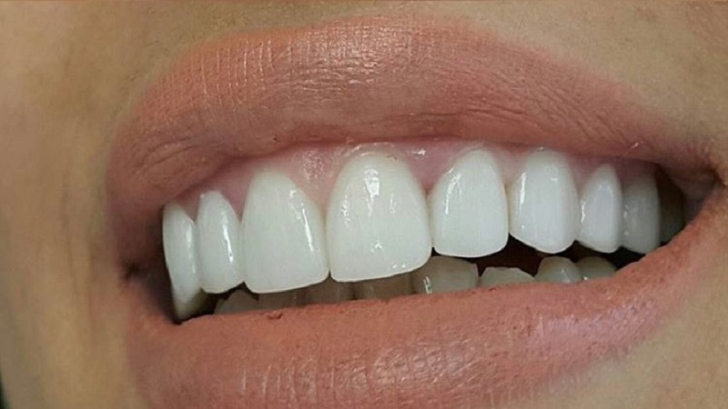 ونیر کامپوزیت