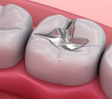 ترمیم دندان با آمالگام