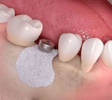 پیوند استخوان