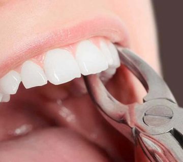 کشیدن دندان