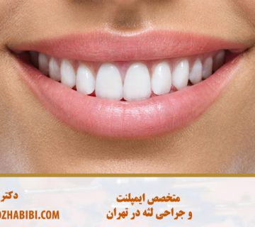 متخصص ایمپلنت در تهران