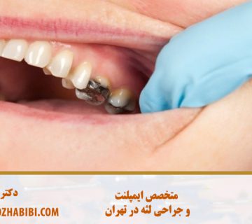 متخصص ایمپلنت در تهران