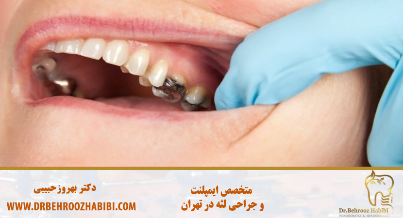 متخصص ایمپلنت در تهران