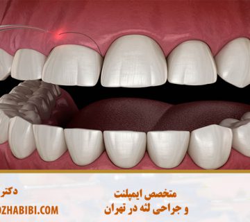 جراحی لثه با لیزر