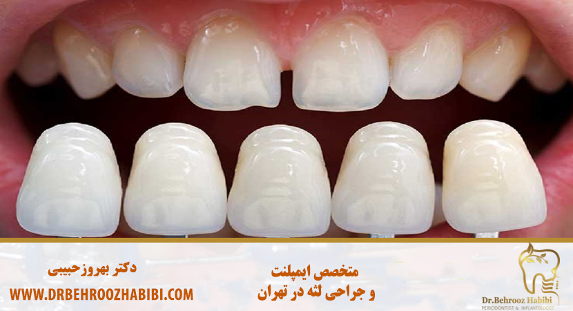 متخصص ایمپلنت در تهران