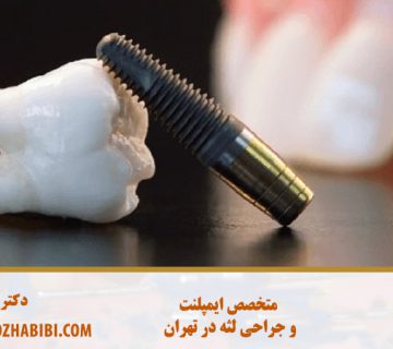متخصص ایمپلنت در تهران