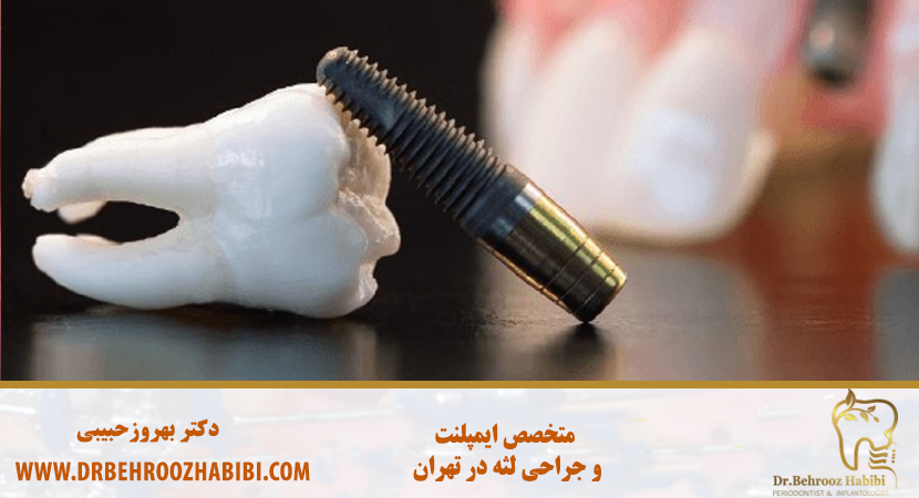 متخصص ایمپلنت در تهران