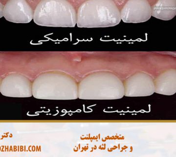 متخصص ایمپلنت