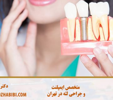 متخصص ایمپلنت