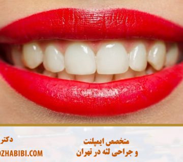 متخصص ایمپلنت در تهران