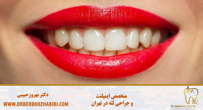 متخصص ایمپلنت در تهران