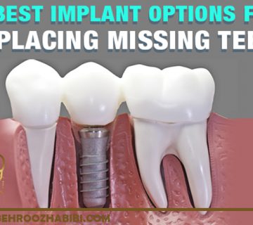 ایمپلنت پل پروتز جزئی