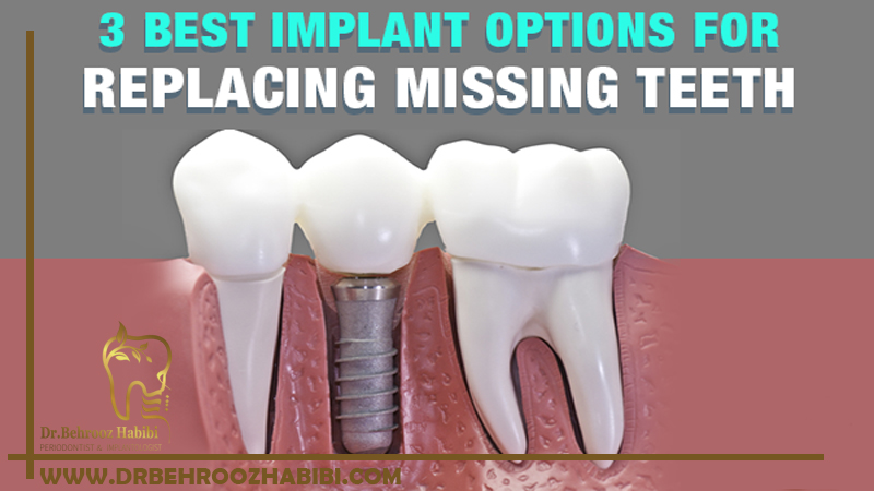 ایمپلنت پل پروتز جزئی