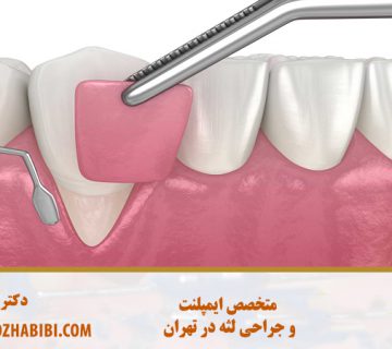 پیوند لثه در تهران