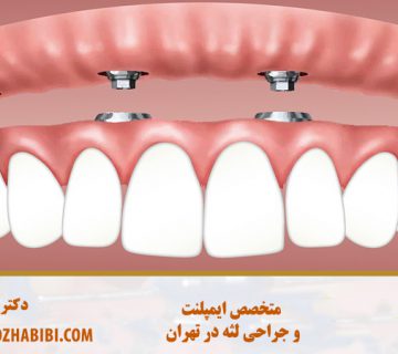 کاشت دندان در تهران