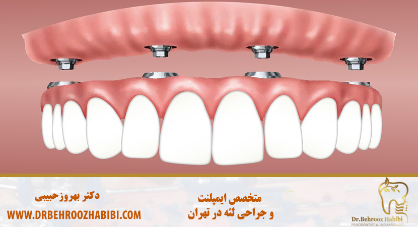 کاشت دندان در تهران