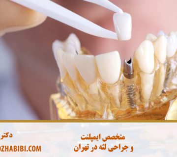 ایمپلنت دندان در تهران