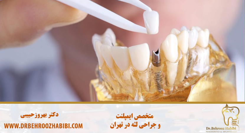 ایمپلنت دندان در تهران