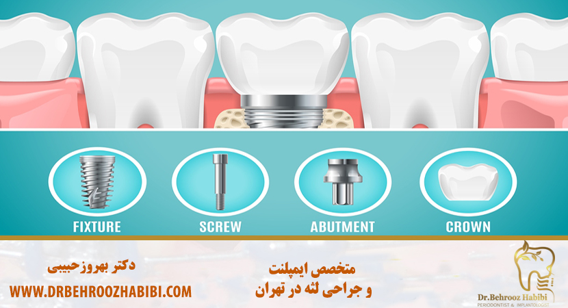کاشت ایمپلنت در تهران