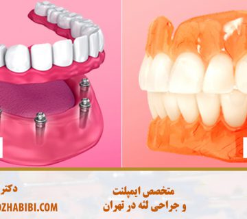 بهترین متخصص ایمپلنت در تهران