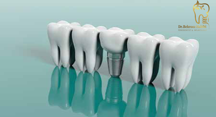 ایمپلنت پل پروتز جزئی