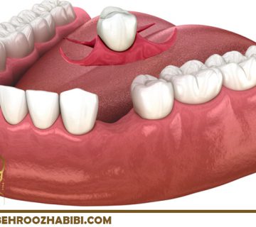 ایمپلنت دندان