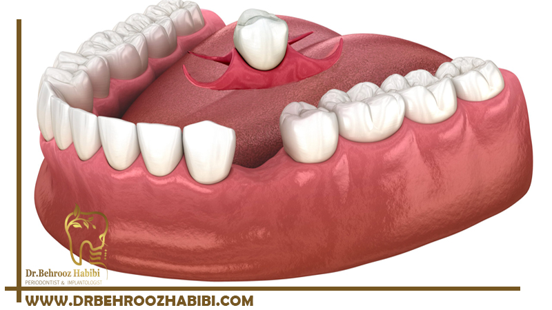 ایمپلنت دندان