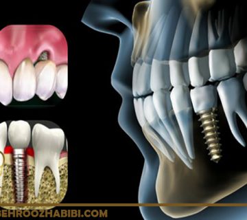 مشکلات ایمپلنت دندان