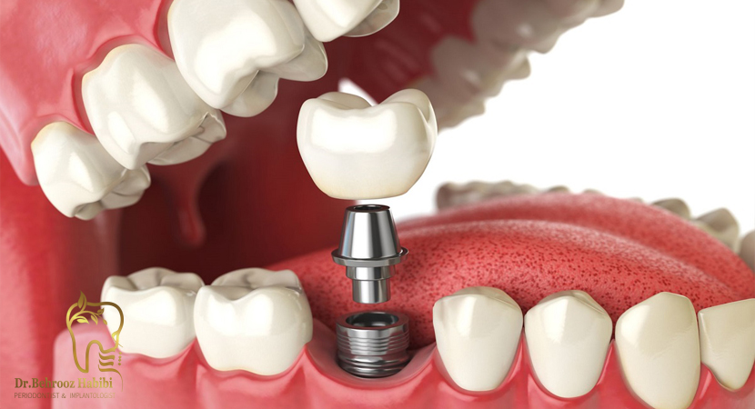 مشکلات ایمپلنت دندان