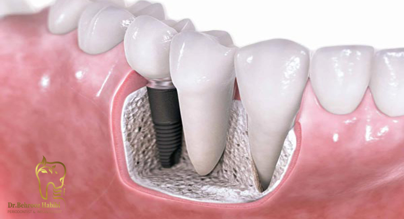مشکلات ایمپلنت دندان