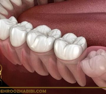 برداشتن دندان عقل