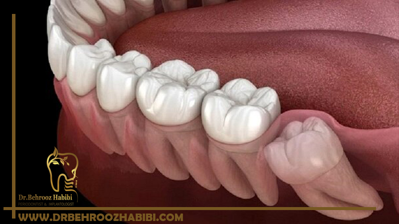 برداشتن دندان عقل