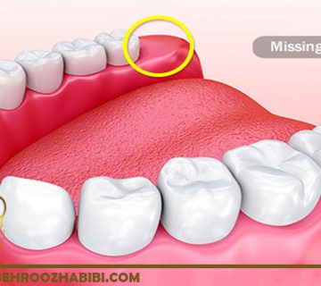 جراحی دندان عقل در تهران