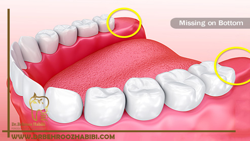 جراحی دندان عقل در تهران