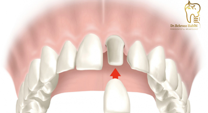 انواع پروتزهای دندان