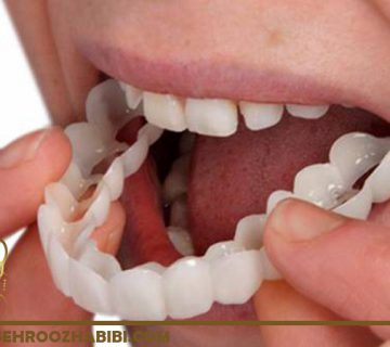 انواع پروتزهای دندان