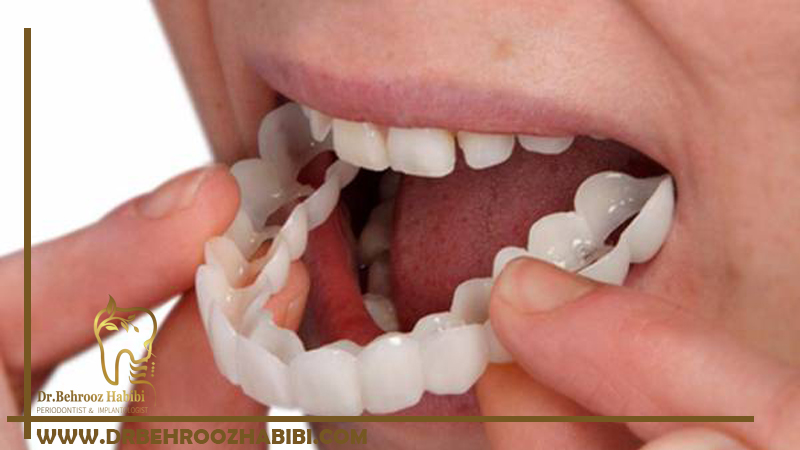 انواع پروتزهای دندان