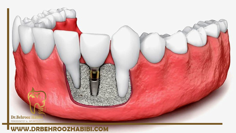 جایگزین ایمپلنت دندان