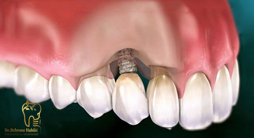 جایگزین ایمپلنت دندان